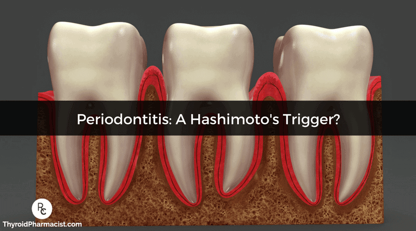 Periodontitis A Hashimoto's Trigger