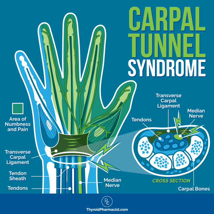 Carpal Tunnel Syndrome